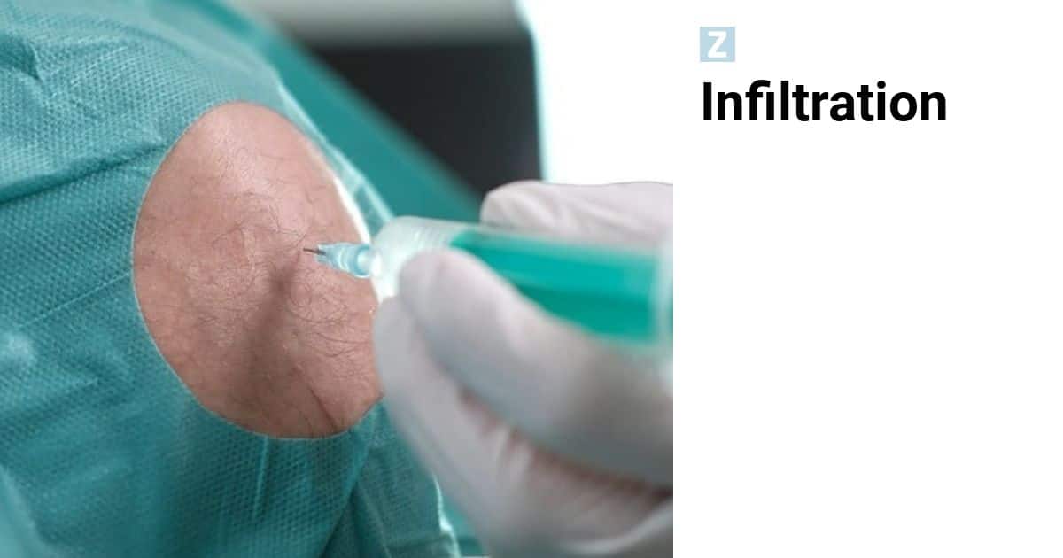 Iv Infiltrationszeichen